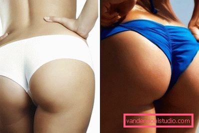 gluteoplastika gluteoplastika