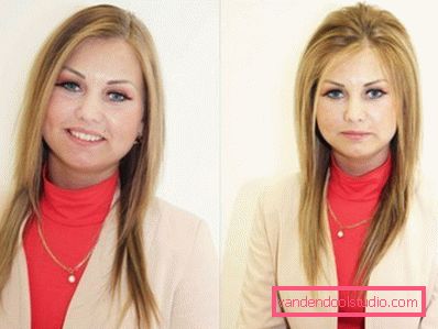 Radikalen volumen las Boost Up (Boost UP) - vse o postopku