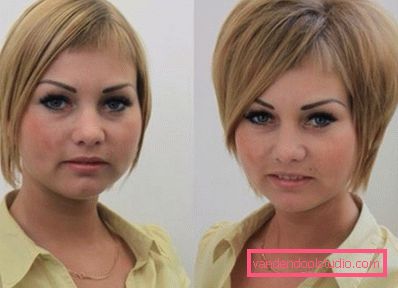 Radikalen volumen las Boost Up (Boost UP) - vse o postopku