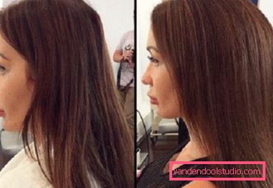 Radikalen volumen las Boost Up (Boost UP) - vse o postopku